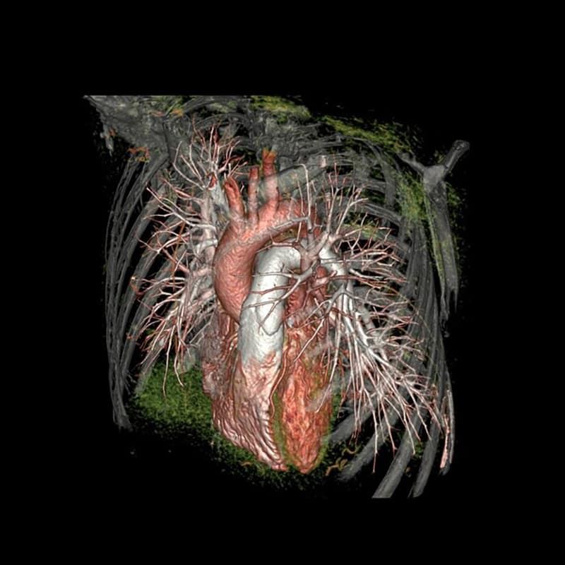 Спектральная КТ-система 256 срезов Revolution Discovery CT
